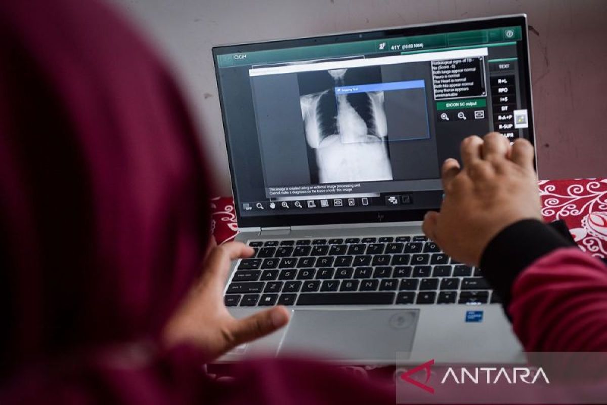 Spesialis Paru sarankan pasien TBC konsumsi obat secara konsisten