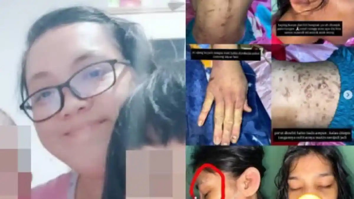 Isi Chat dan Luka Jadi Bukti, ART di Bogor Korban Penganiayaan Oknum ASN BPK Masih Berobat ke Dokter